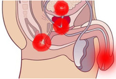 Приехали: хронический простатит